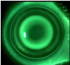 Les lentilles de nuit d'orthok�ratologie : K�sako ? Tout savoir sur ces lentilles r�volutionnaires gr�ce � votre opticien � Cannes