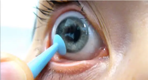 Les lentilles rigides pour myopie, astigmatisme, hyperm�tropie, presbytie et k�ratoc�ne chez Californie optique � Cannes dans les Alpes Maritimes